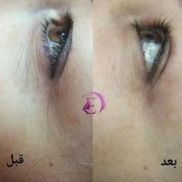رفع سیاهی و چین و چروک دور چشم در شیراز