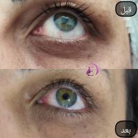 رفع سیاهی و چین و چروک دور چشم در شیراز