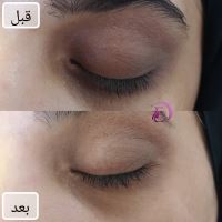 رفع سیاهی و چین و چروک دور چشم در شیراز