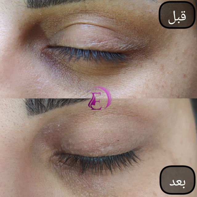 رفع سیاهی و چین و چروک دور چشم در شیراز