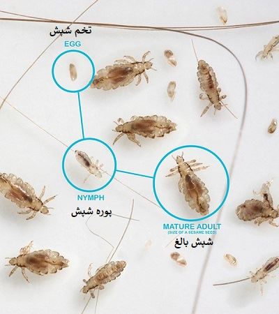درمان قطعی شپش سر اصفهان