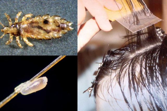 درمان تضمینی شپش سر اصفهان