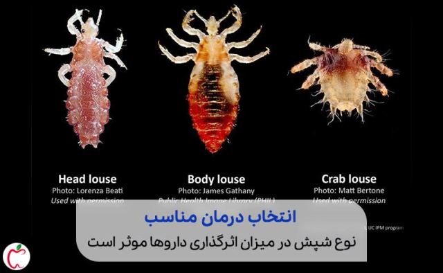 درمان شپش سر اصفهان