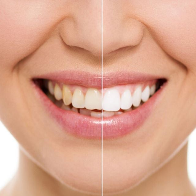 بهترین دکترکامپوزیت دندان در شیراز دکتر مریم مرادی