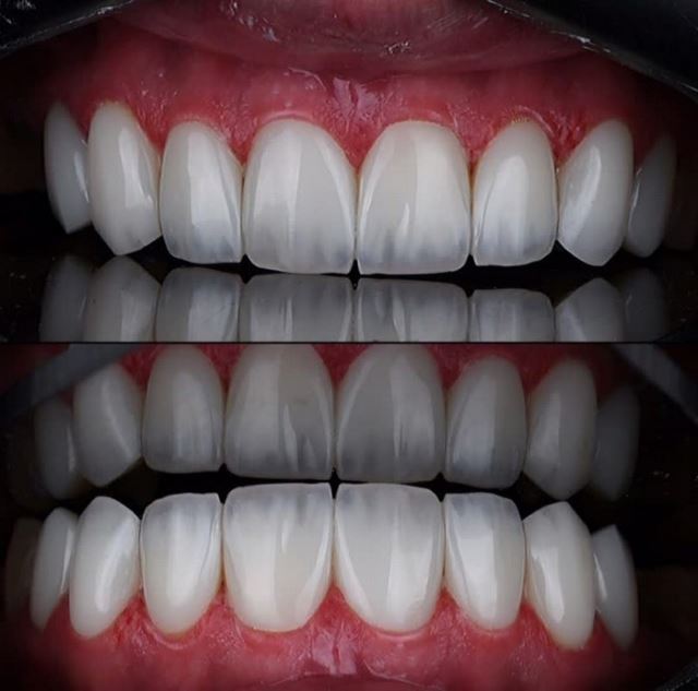 بهترین دکترکامپوزیت دندان در شیراز دکتر مریم مرادی