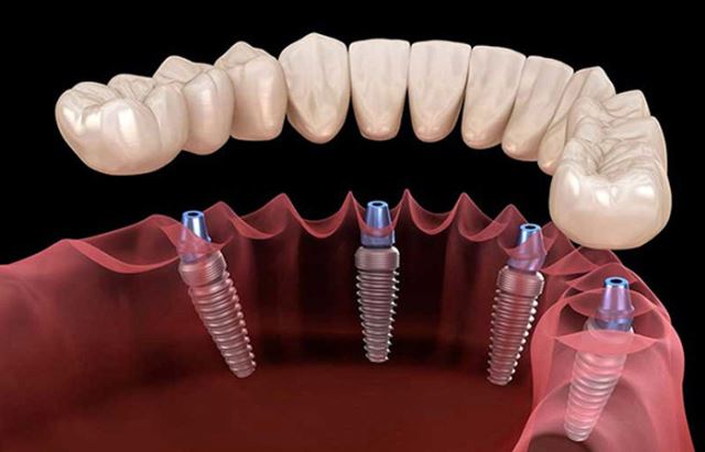 زراعة الأسنان الفورية في تبريز