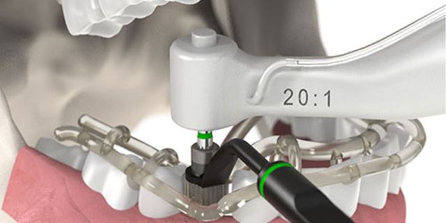 زراعة الأسنان الفورية في تبريز