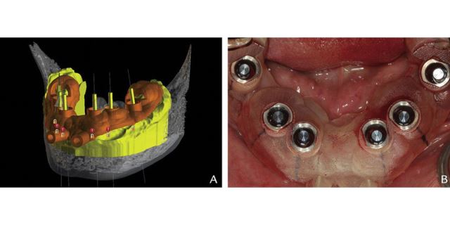 زراعة الأسنان الفورية في تبريز