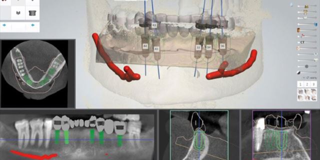 زراعة الأسنان الفورية في تبريز