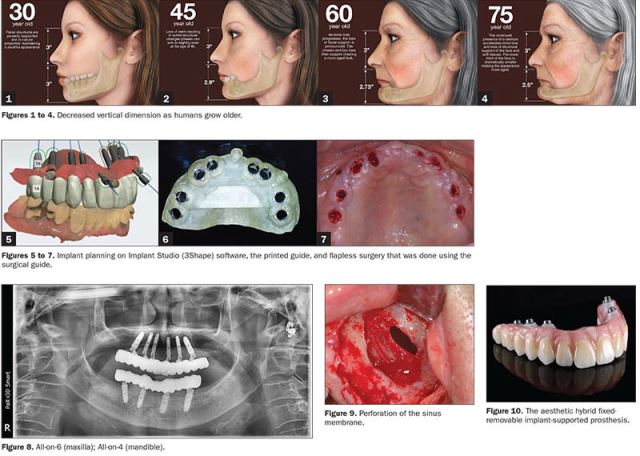 زراعة الأسنان الفورية في تبريز
