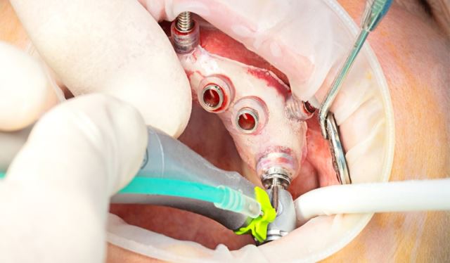 زراعة الأسنان الفورية في تبريز 