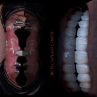 ایمپلنت فوری در تبریز