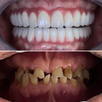 ایمپلنت فوری در تبریز