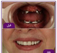 ایمپلنت فوری در تبریز