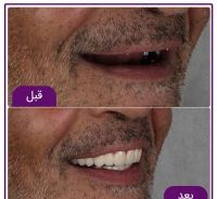 ایمپلنت فوری در تبریز