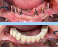 ایمپلنت فوری در تبریز
