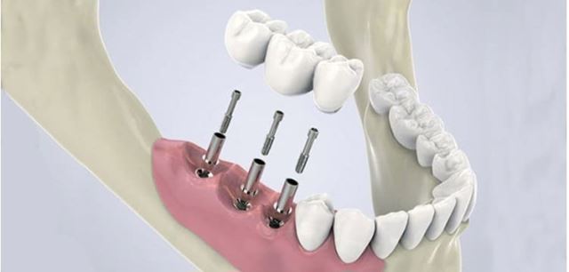 زراعة الأسنان الفورية في تبريز
