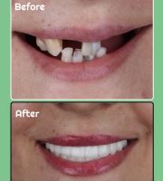 ایمپلنت فوری در تبریز