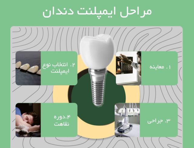 ایمپلنت فوری در تبریز
