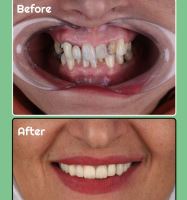 ایمپلنت فوری در تبریز