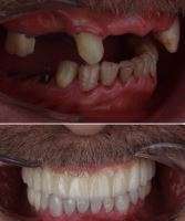 ایمپلنت فوری در تبریز