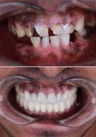 ایمپلنت فوری در تبریز