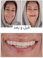 ایمپلنت فوری در تبریز