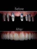 ایمپلنت فوری در تبریز