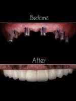 ایمپلنت فوری در تبریز