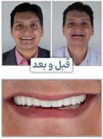 ایمپلنت فوری در تبریز