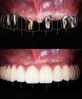 ایمپلنت فوری در تبریز