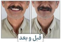 ایمپلنت فوری در تبریز