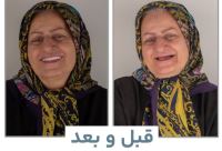 ایمپلنت فوری در تبریز