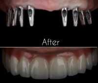 ایمپلنت فوری در تبریز