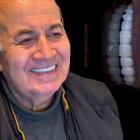 زراعة الأسنان الفورية في تبريز