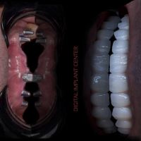 زراعة الأسنان الفورية في تبريز