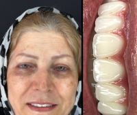 زراعة الأسنان الفورية في تبريز