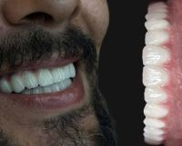 زراعة الأسنان الفورية في تبريز