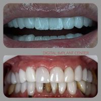 زراعة الأسنان الفورية في تبريز