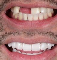 زراعة الأسنان الفورية في تبريز