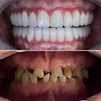 زراعة الأسنان الفورية في تبريز