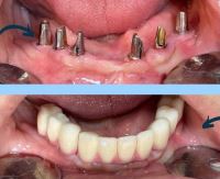 زراعة الأسنان الفورية في تبريز