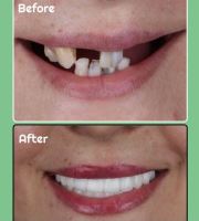 زراعة الأسنان الفورية في تبريز