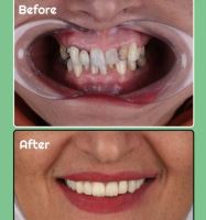 زراعة الأسنان الفورية في تبريز