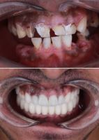 زراعة الأسنان الفورية في تبريز