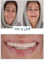 زراعة الأسنان الفورية في تبريز