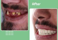 زراعة الأسنان الفورية في تبريز