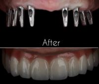 زراعة الأسنان الفورية في تبريز