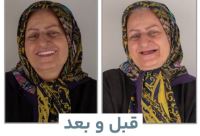 زراعة الأسنان الفورية في تبريز