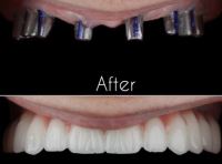 زراعة الأسنان الفورية في تبريز